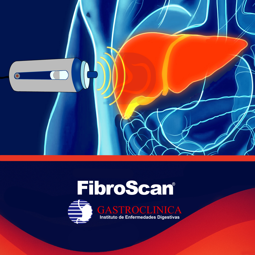 FibroScan - Evaluación no invasiva del hígado